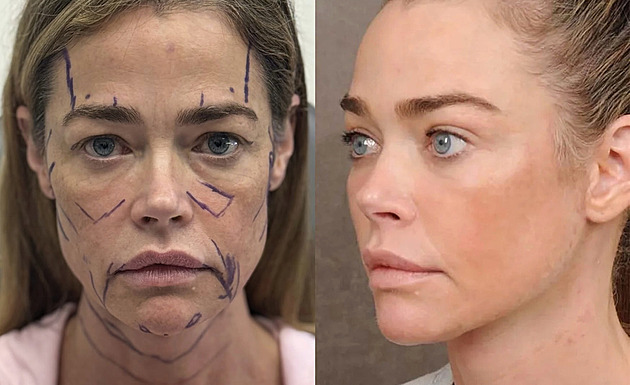 Denise Richardsová podstoupila náročný zákrok, vizuálně omládla o desítky let