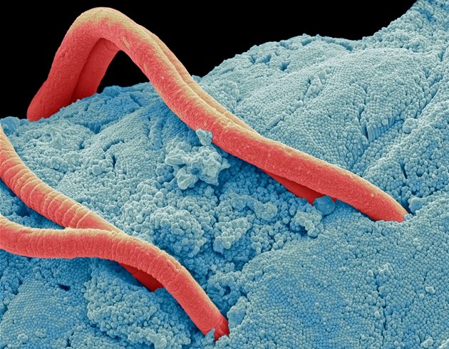 Česnek nepomůže. Roupy vyřeší jen správná léčba